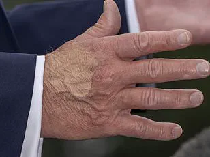 Trump Defies Medical Advice by Continuing High-Dose Aspirin Regimen Despite Physician Warnings