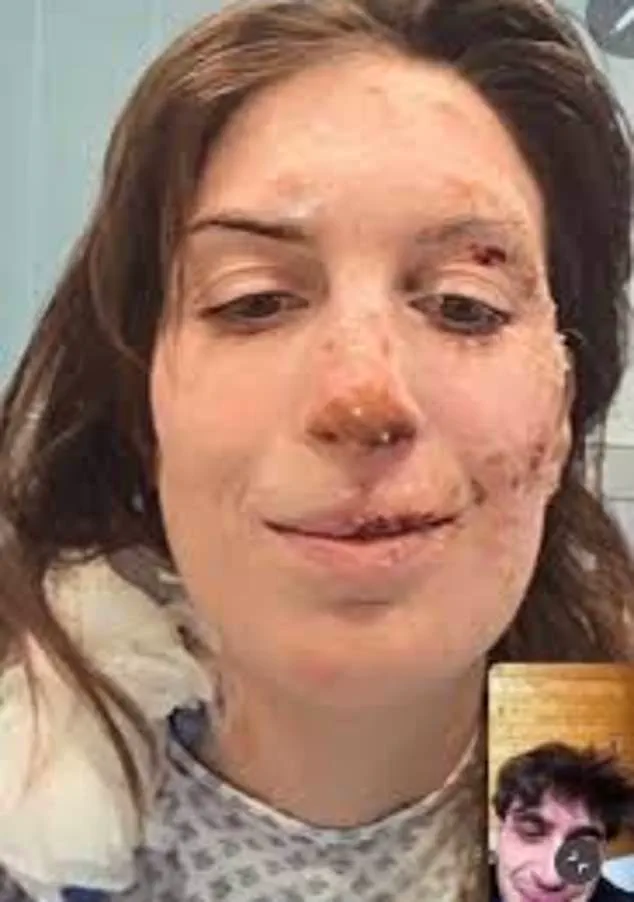 Swiss Nightclub Fire Survivor Eleonora Palmieri Faces Severe Burns and Emotional Scars Highlighting Human Toll