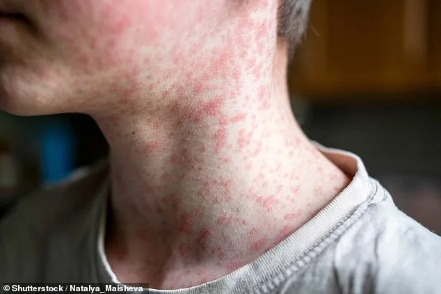Measures Urged as US Faces Measles Resurgence