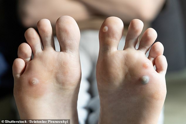 Silent HPV Strain Causes Painful Plantar Warts in Feet