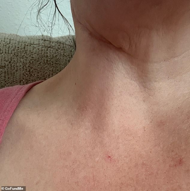 Doctors Missed Cancer Symptoms in Nurse Who Sought Multiple Biopsies
